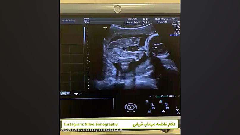 تعیین جنسیت سخت! سونوگرافی نیلو دکتر فاطمه مهتاب قربانی