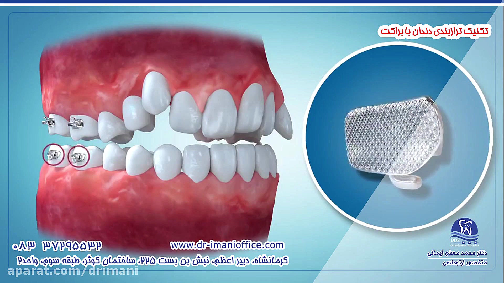 تکنیک ترازبندی دندان با براکت دکتر محمد مسلم ایمانی - متخصص ارتودنسی در کرمانشاه