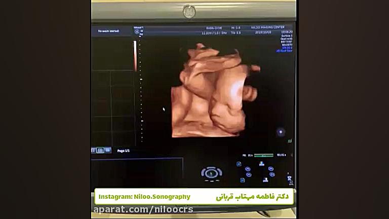 دوقلوی دختر در دوران جنینی سونوگرافی نیلو دکتر فاطمه مهتاب قربانی
