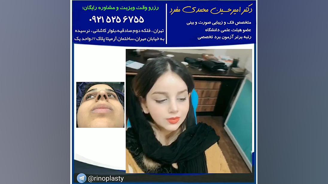 عمل جراحی زیبایی بینی (دکتر امیرحسین محمدی مفرد) دکتر امیر حسین محمدی مفرد