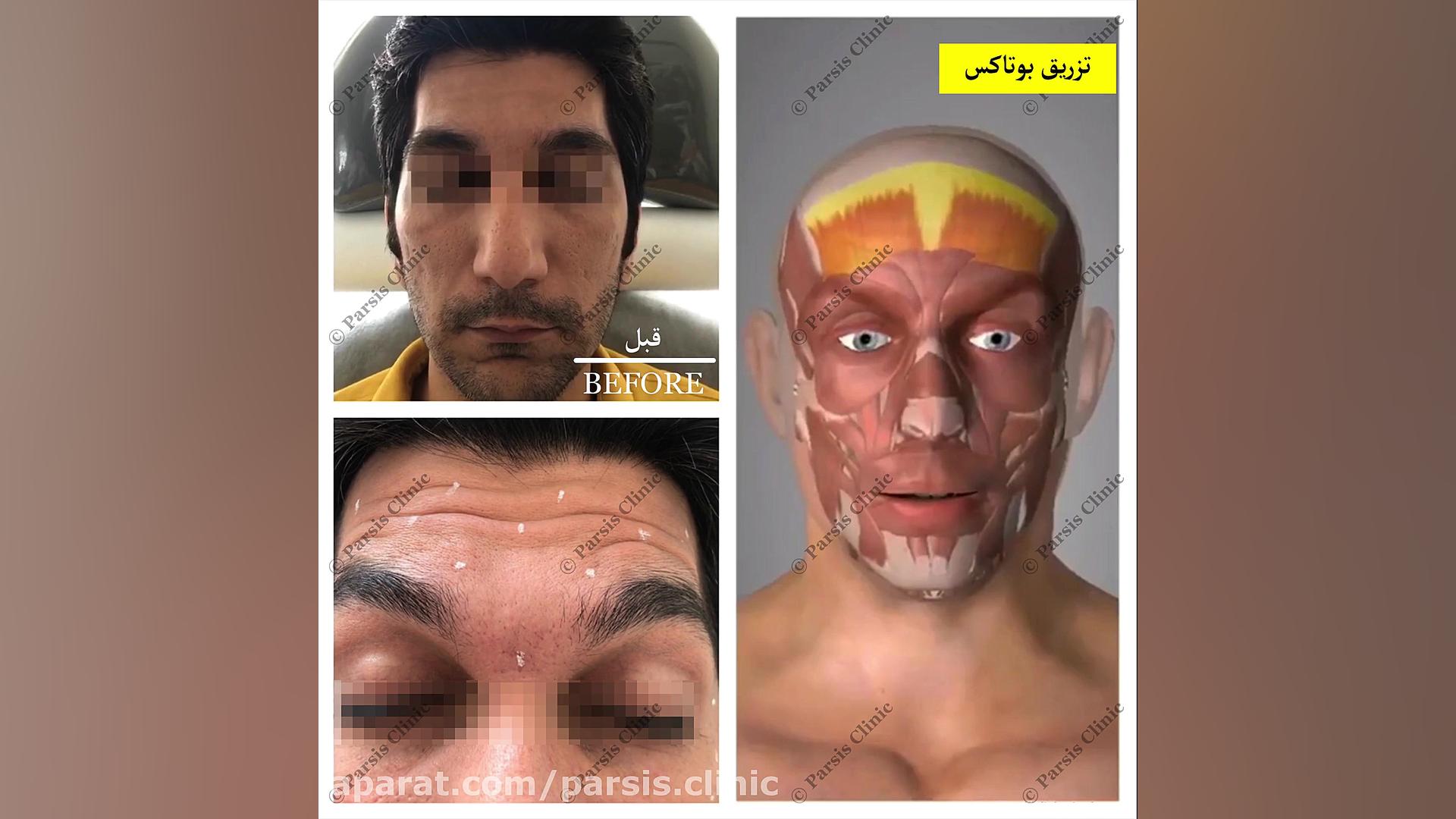 تزریق بوتاكس دیسپورت در ناحیه پیشانى، اخم و خطوط پنجه كلاغى کلینیک تخصصی پوست،زیبایی،لیزر و کاشت مو پارسیس