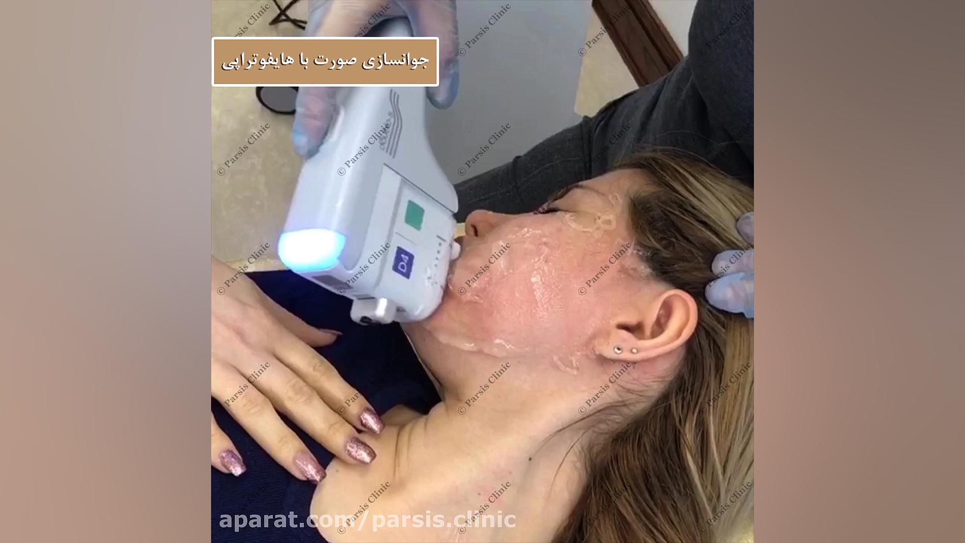 هایفوتراپی با دابلو کلینیک تخصصی پوست،زیبایی،لیزر و کاشت مو پارسیس