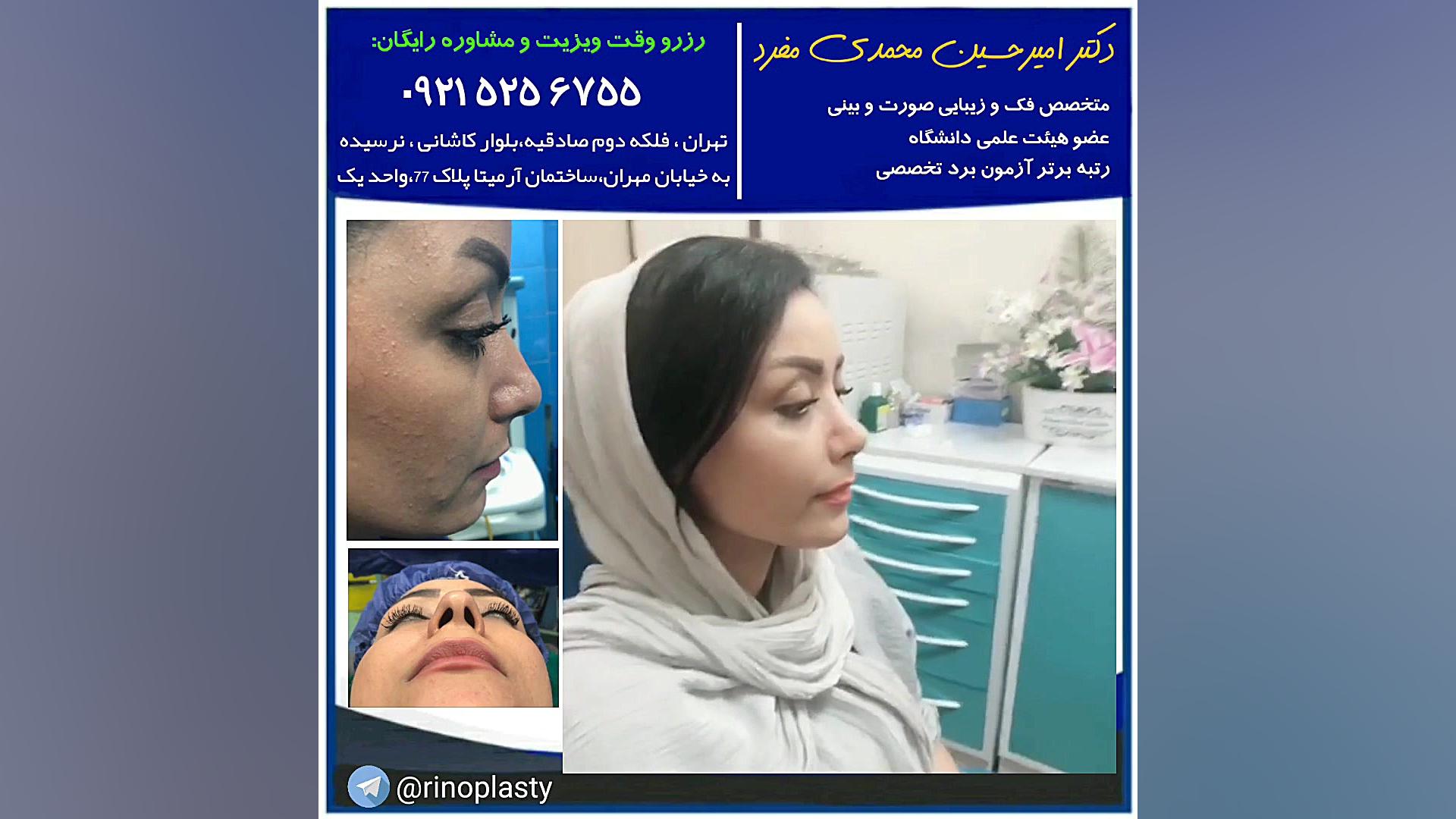 عمل جراحی زیبایی بینی (دکتر امیرحسین محمدی مفرد) دکتر امیر حسین محمدی مفرد