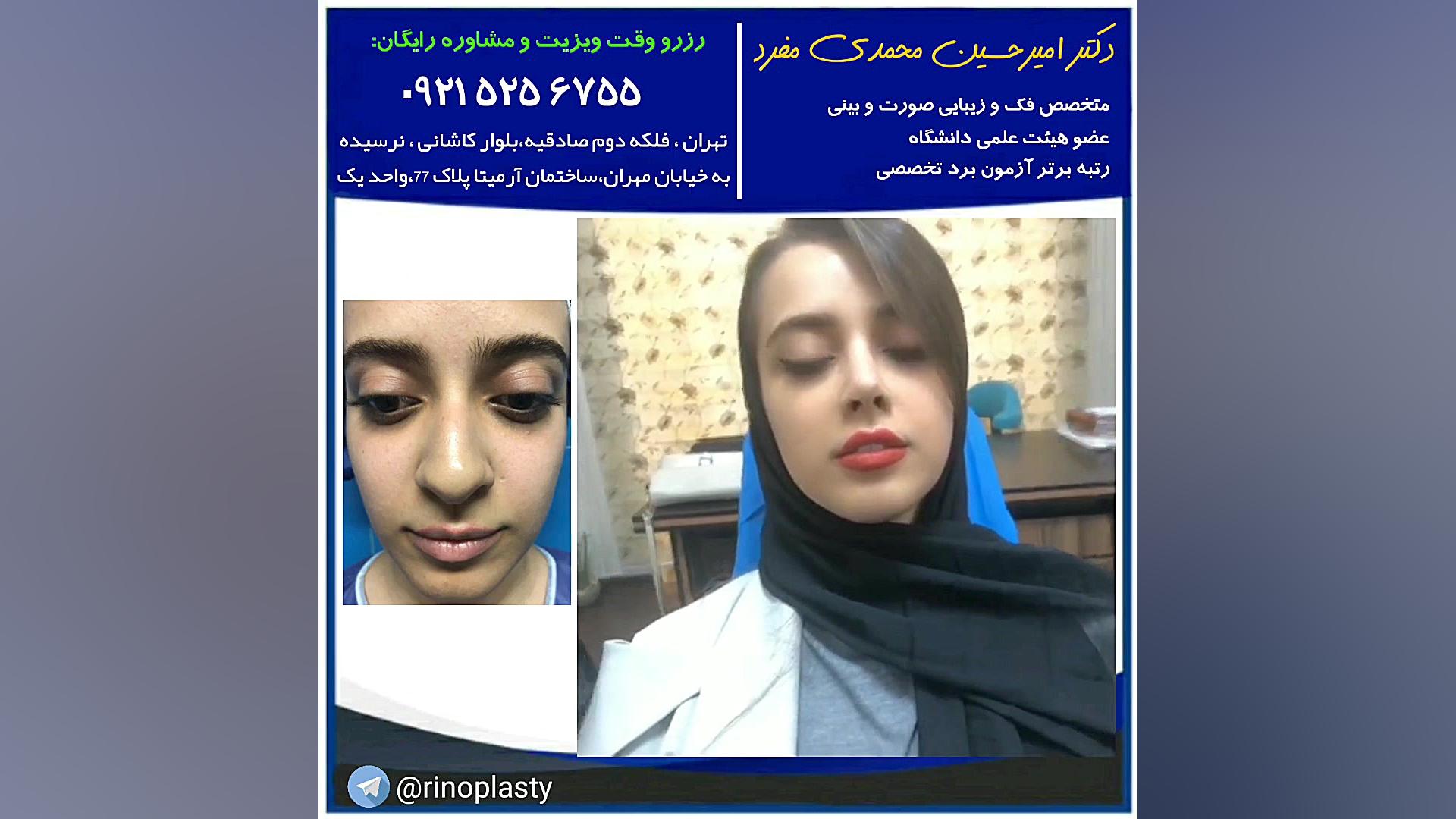 عمل جراحی زیبایی بینی (دکتر امیرحسین محمدی مفرد) دکتر امیر حسین محمدی مفرد