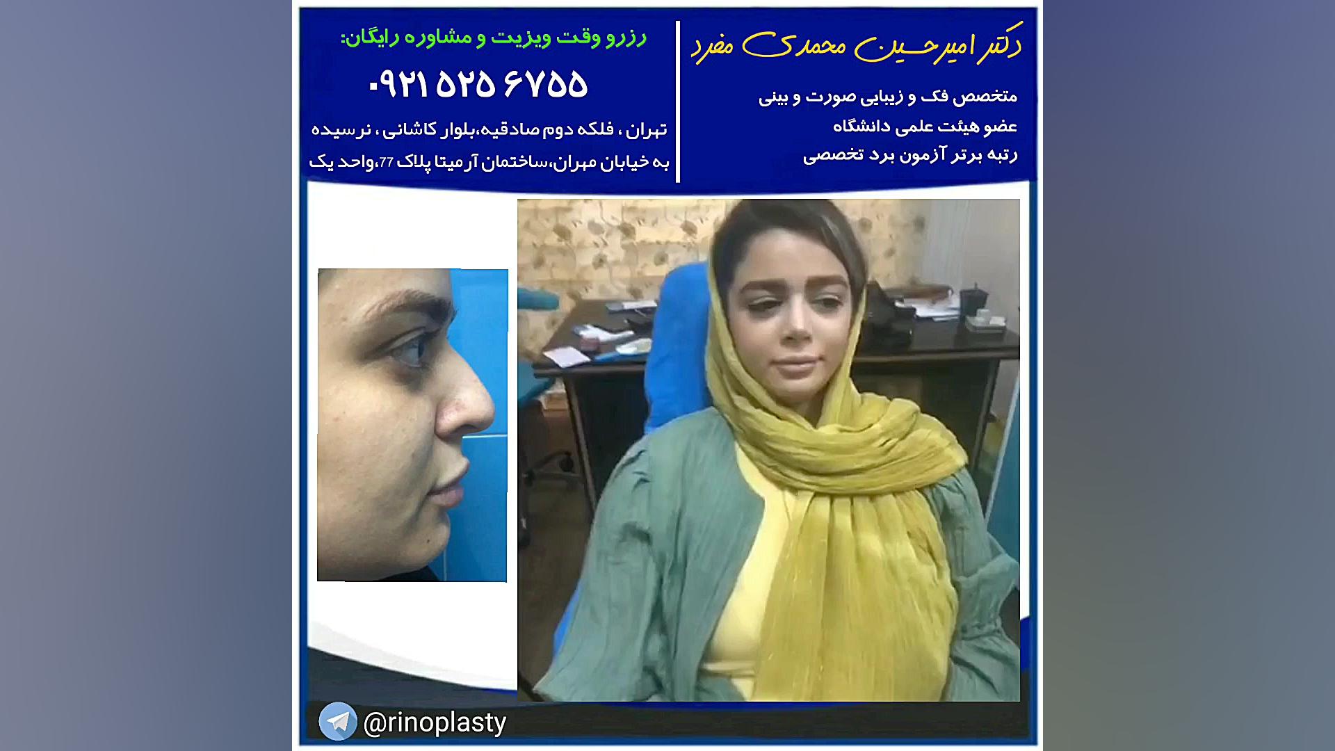 عمل جراحی زیبایی بینی (دکتر امیرحسین محمدی مفرد) دکتر امیر حسین محمدی مفرد