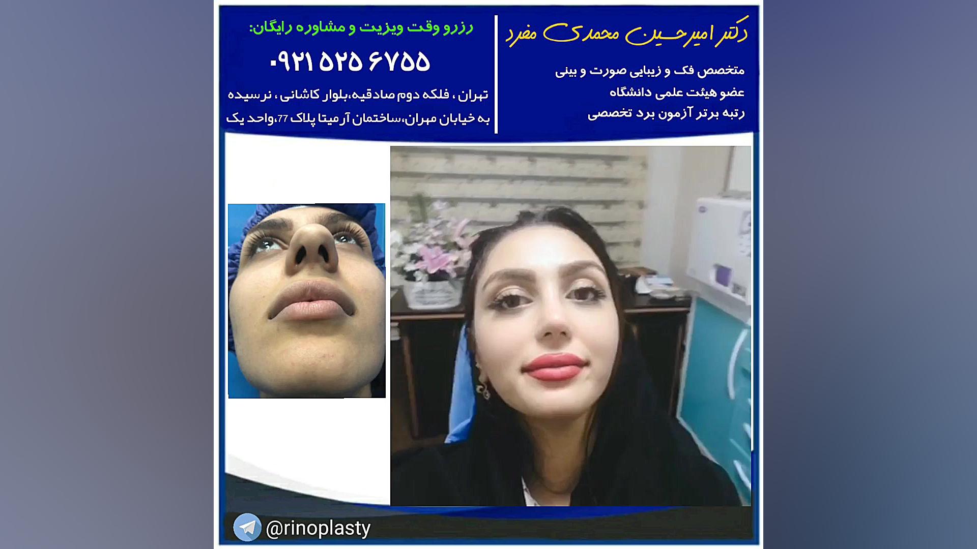 عمل جراحی زیبایی بینی (دکتر امیرحسین محمدی مفرد) دکتر امیر حسین محمدی مفرد