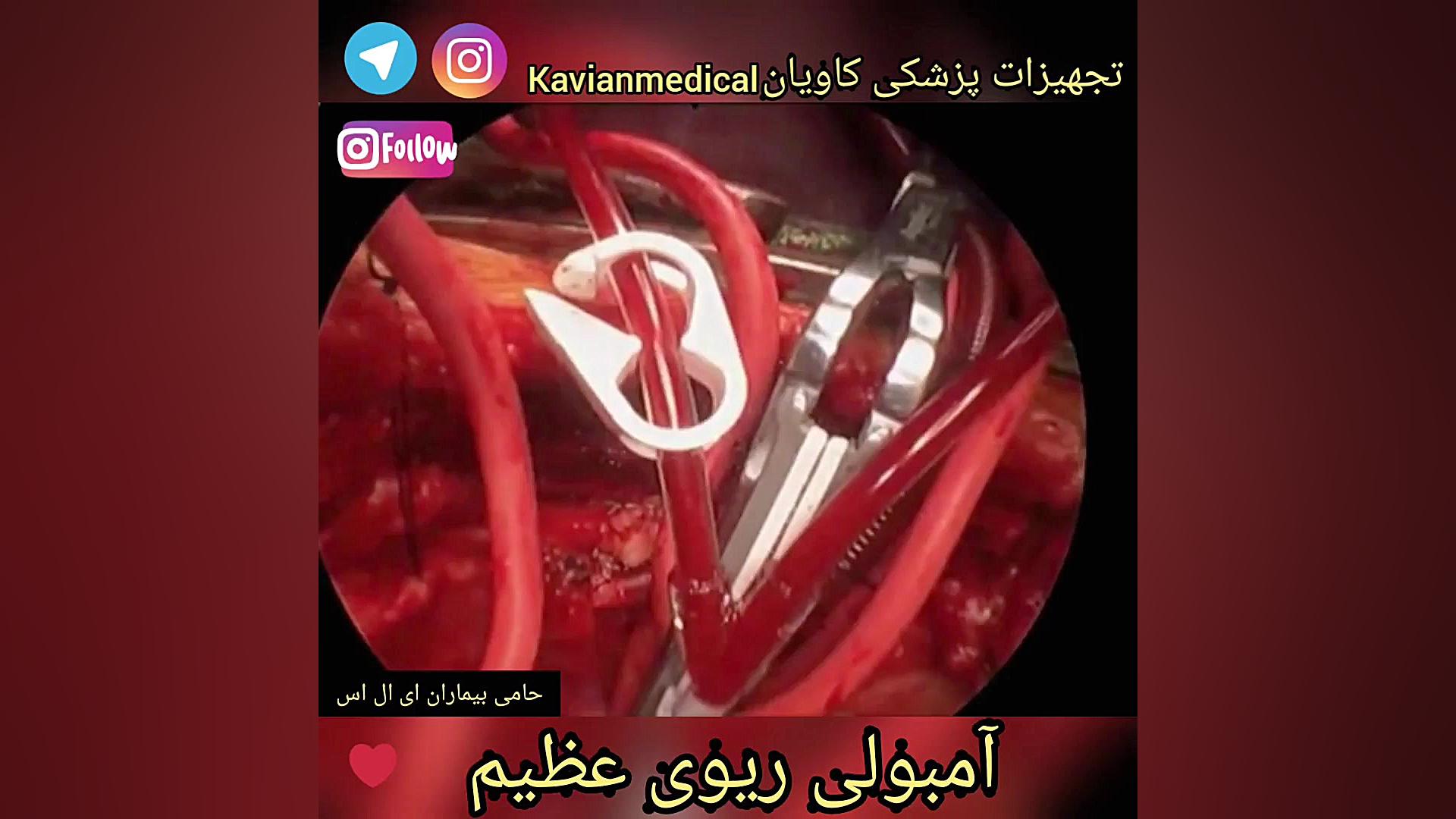 آمبولی ریوی عظیم تست مهار دگزامتازون