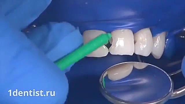 ترمیم پوسیدگی دندان-دکترمجیدقیاسی-دندانپزشک زیبایی مشهد دکترمجیدقیاسی