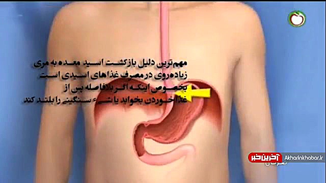 چرا دچار ریفلاکس معده یا همان ترش کردن می شویم؟ اتوپلاستی