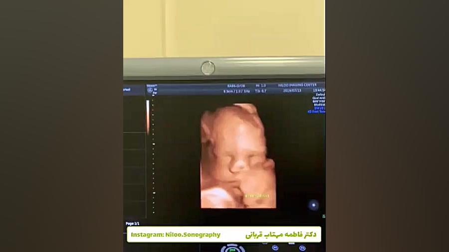 اندازه سر جنین سونوگرافی نیلو دکتر فاطمه مهتاب قربانی