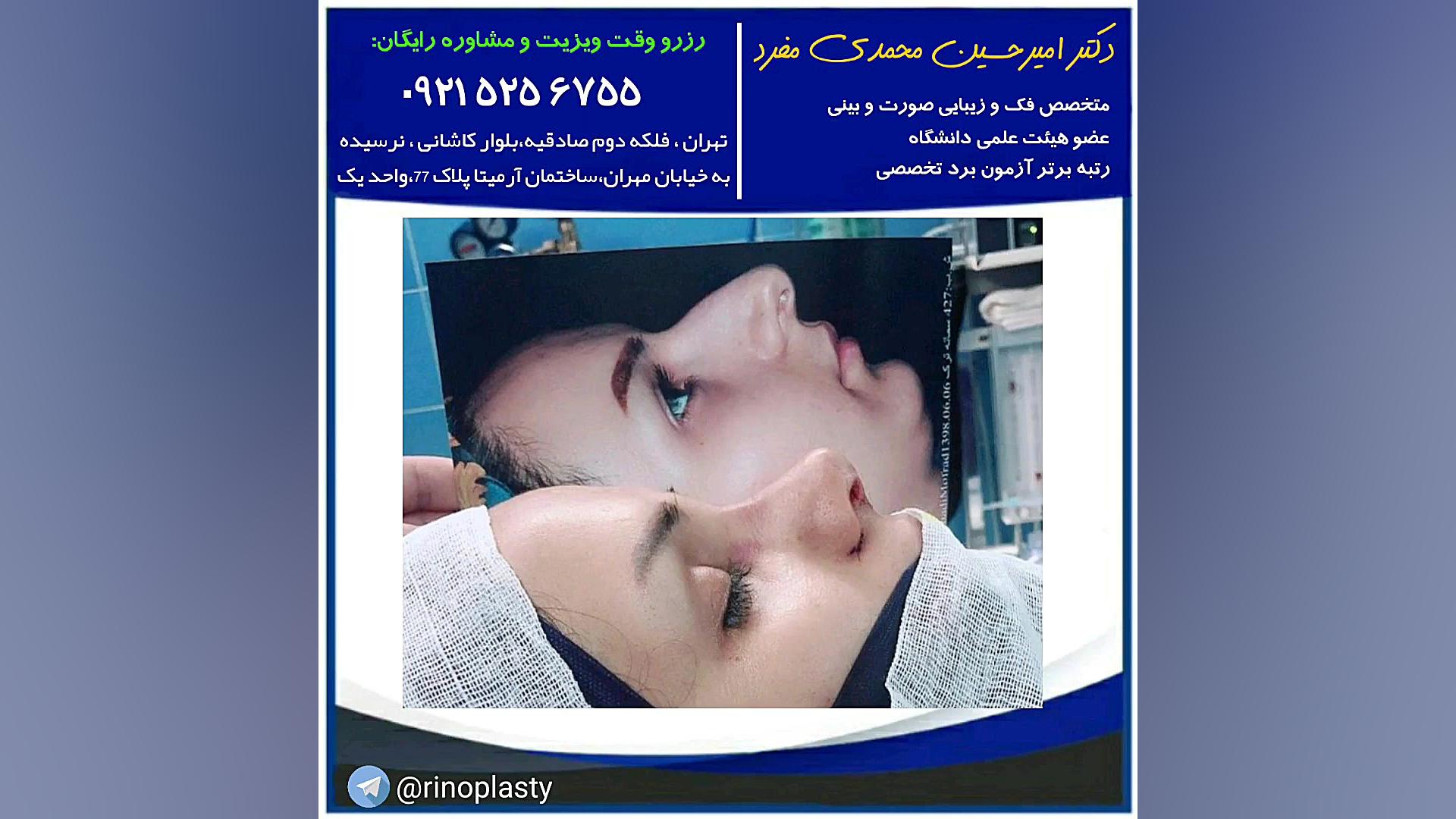 عمل زیبایی بینی (دکتر امیر حسین محمدی مفرد) دکتر امیر حسین محمدی مفرد