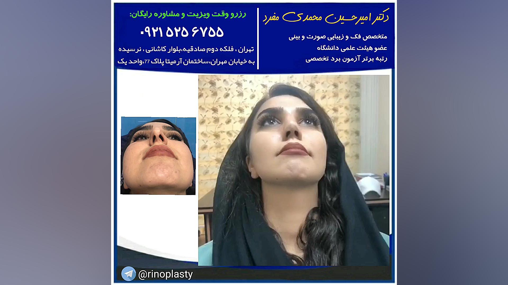 عمل زیبایی بینی (دکتر امیر حسین محمدی مفرد) دکتر امیر حسین محمدی مفرد