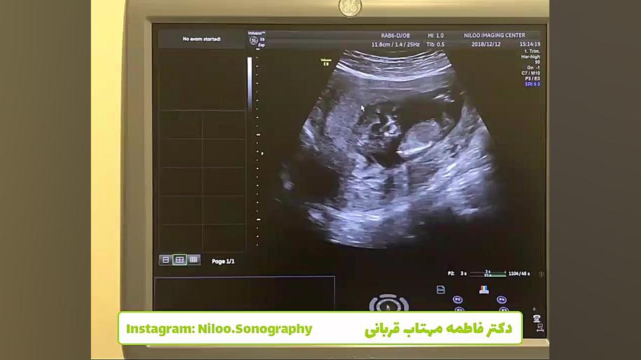 جفت سرراهی سونوگرافی نیلو دکتر فاطمه مهتاب قربانی