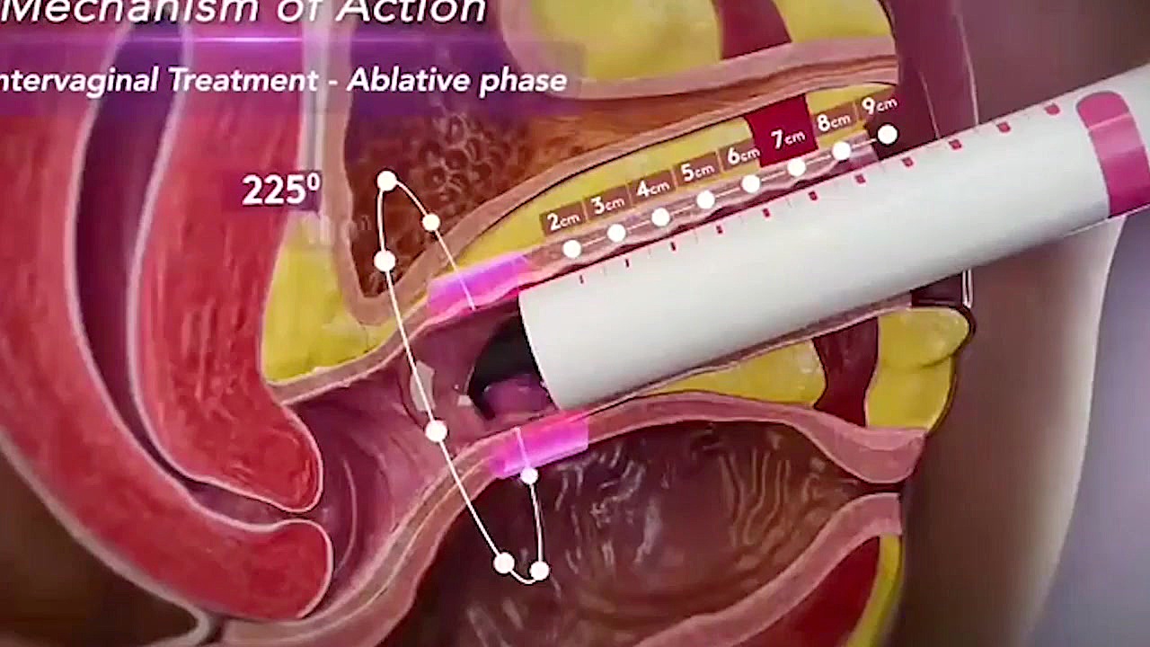 لیزر ژولیت ترمیم سوختگی