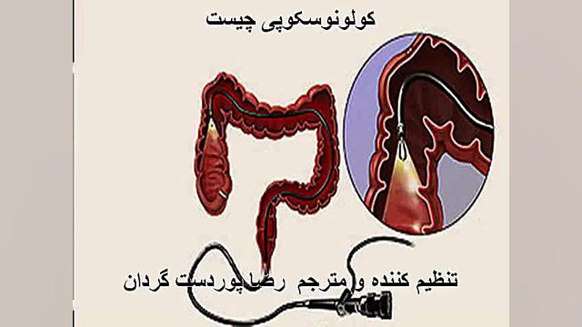 کولونوسکوپی لیفت پیشانی