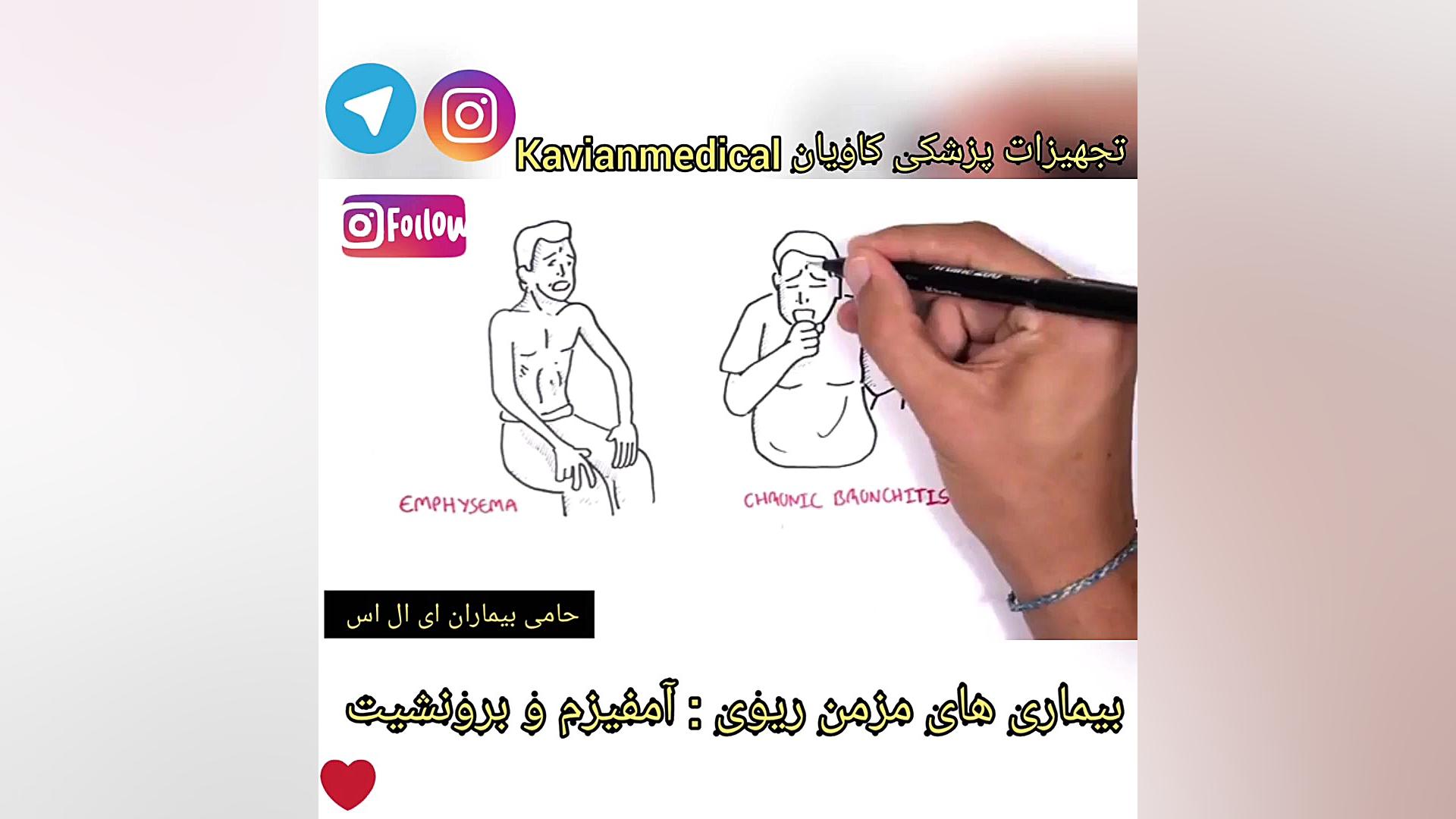 بیماری های مزمن ریوی: آمفیزم و برونشیت لیفت صورت
