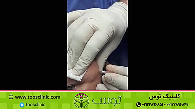 تخلیه ژل پاژ که قبلا در کلینیک دیگری تزریق شده کلینیک زیبایی