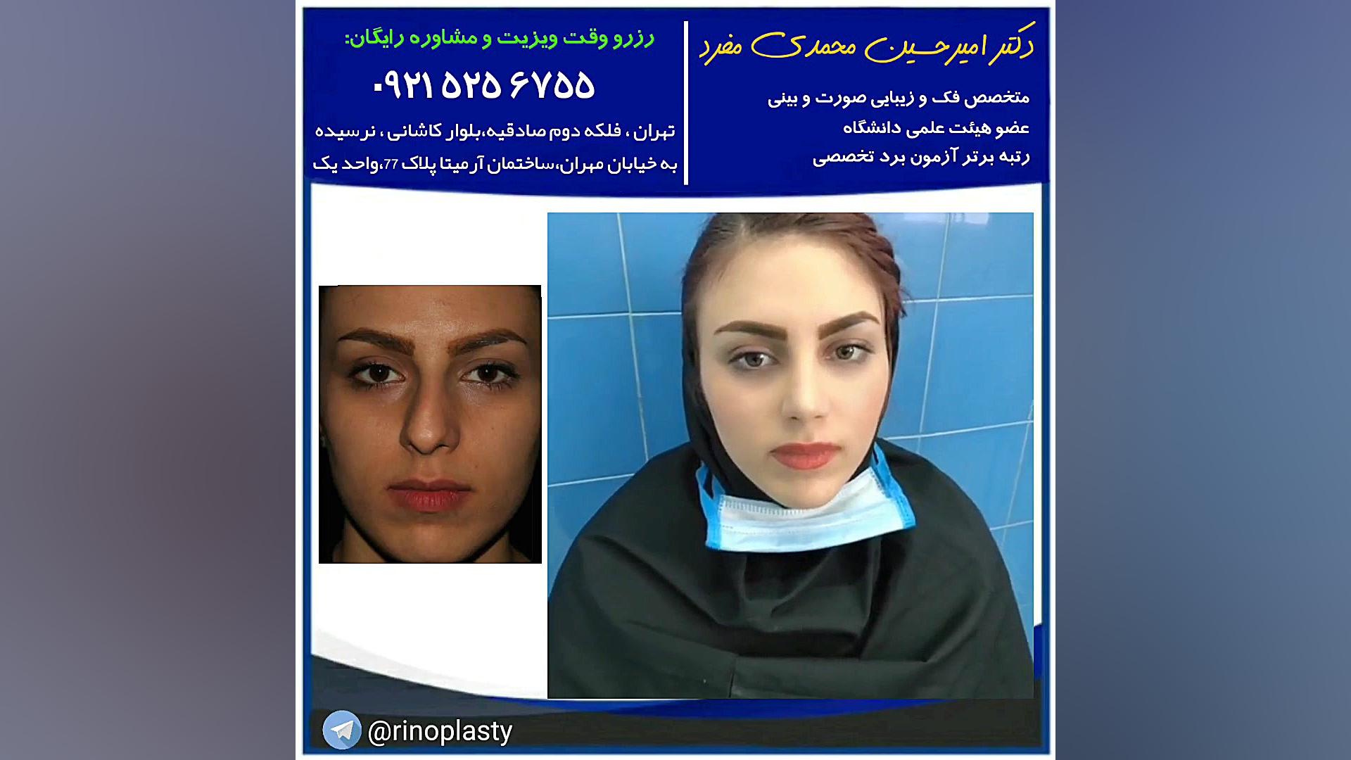عمل زیبایی بینی (دکتر امیر حسین محمدی مفرد) دکتر امیر حسین محمدی مفرد