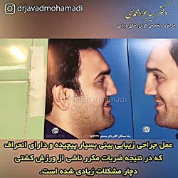 جراحی بینی بسیار پیچیده