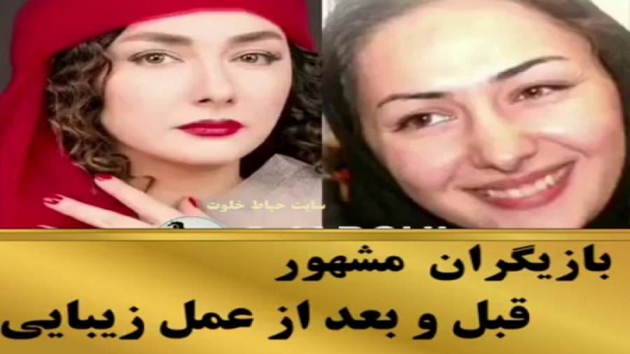 بازیگران زن ایرانی قبل و بعد از عمل زیبایی و آرایش بیماری گلوکوزامینوگلیکان تجمعی