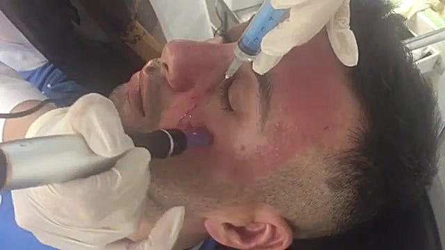 میکرونیدلینگ دکتر پن AC علامت کرنیگ