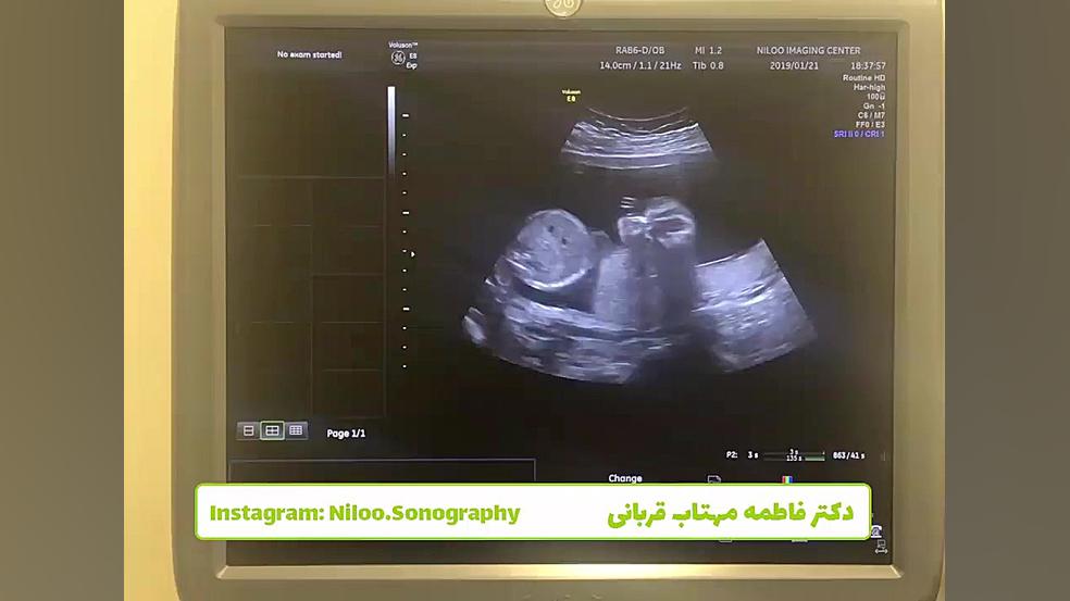 دردهای بارداری بلیچینگ