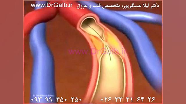استنت یعنی چه؟ بالون یعنی چه؟ - دکتر لیلا عسگرپور متخصص قلب و عروق زاویه سازی صورت