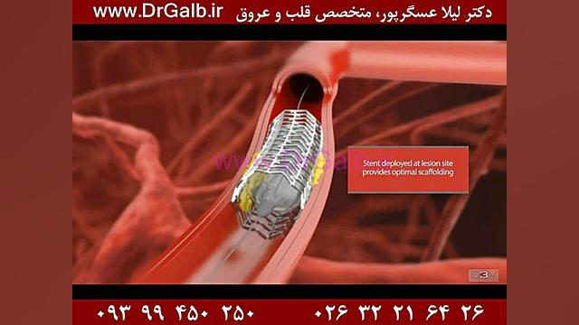 آنژیوگرافی را چطور انجام می دهند؟ دندانپزشک زیبایی