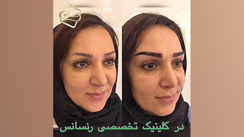 کاشت ابرو - تکنیک جدید کاشت ابرو کلینیک رنسانس توپلیزوماب