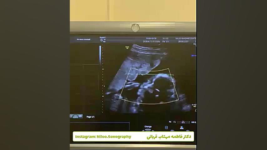 طول سرویکس و سرکلاژ سونوگرافی نیلو دکتر فاطمه مهتاب قربانی