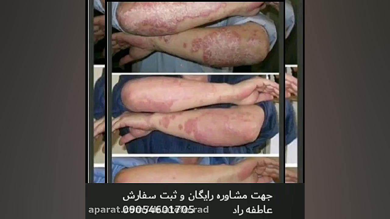 اولین درمان قطعی بیماری پسوریازیس در ایران رفع چین و چروک