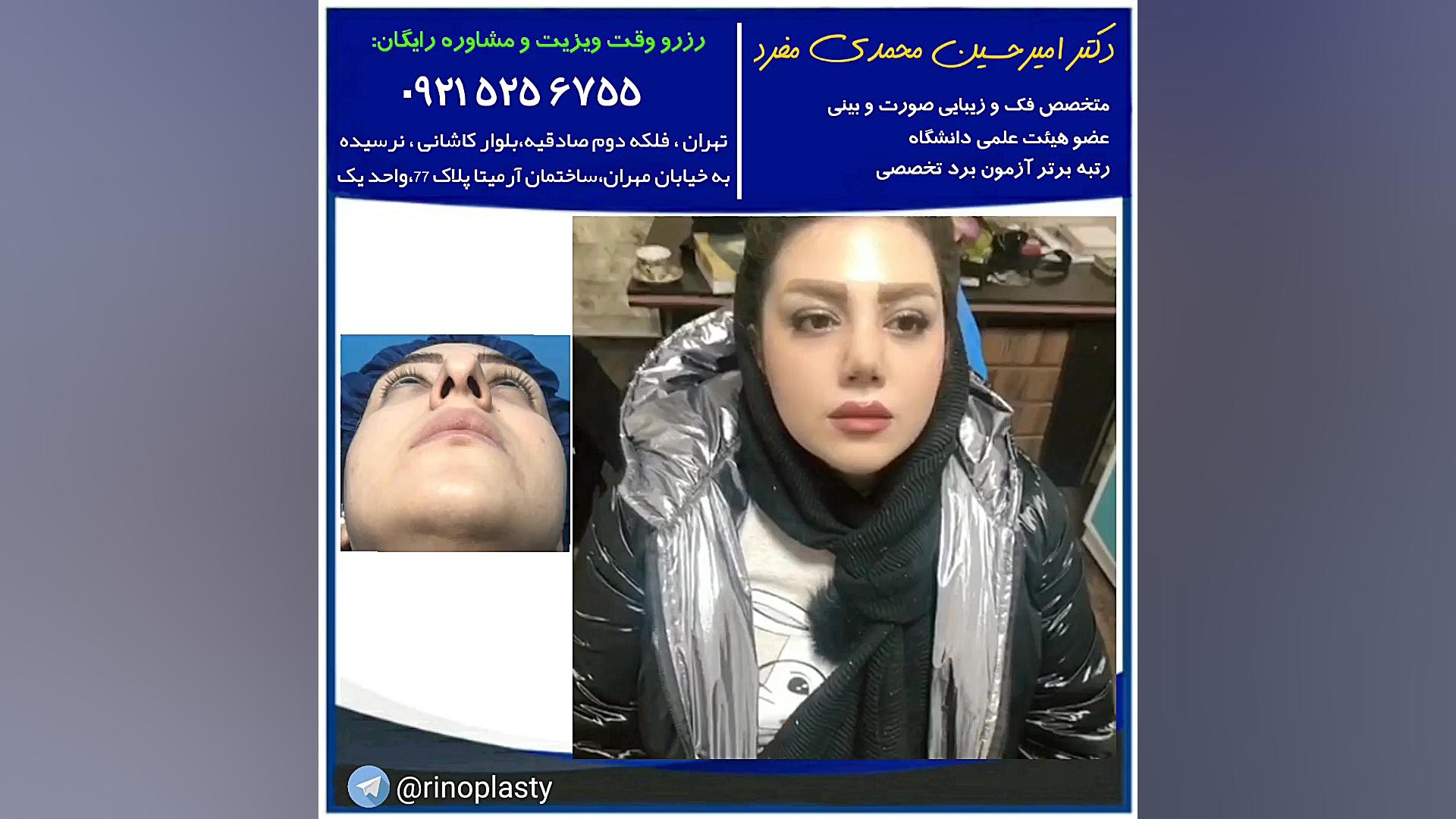 عمل زیبایی بینی (دکتر امیر حسین محمدی مفرد) دکتر امیر حسین محمدی مفرد