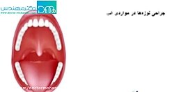 عمل لوزه در چه صورتی لازم است؟