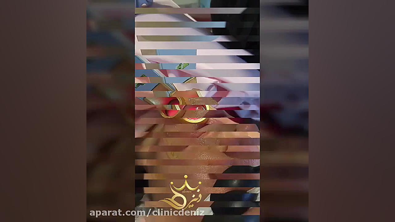 لیزر موهای زائد با دستگاه الکساندرایت کوترا لیزر مو