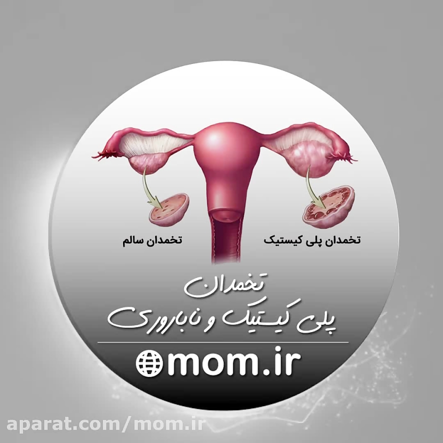 تخمدان پلی کیستیک و ناباروری