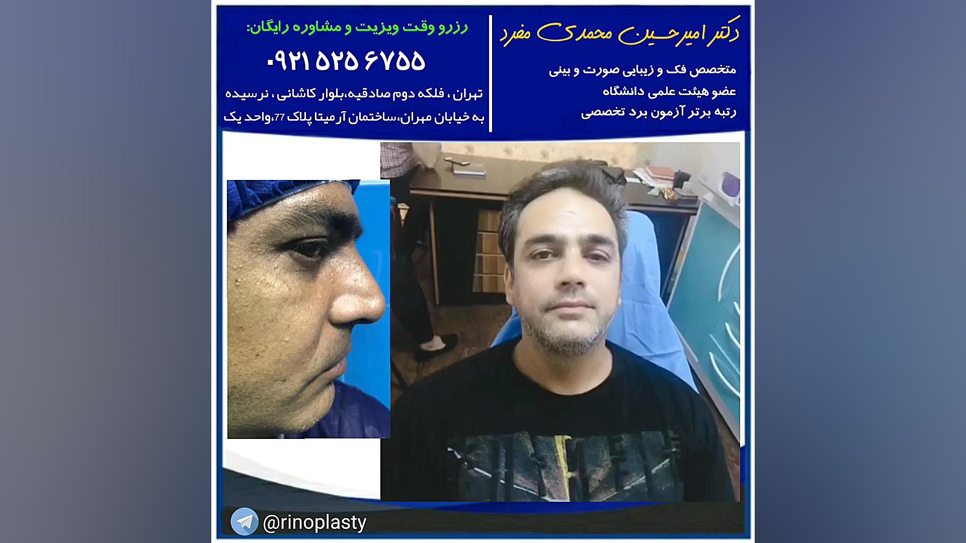عمل زیبایی بینی (دکتر امیر حسین محمدی مفرد) دکتر امیر حسین محمدی مفرد