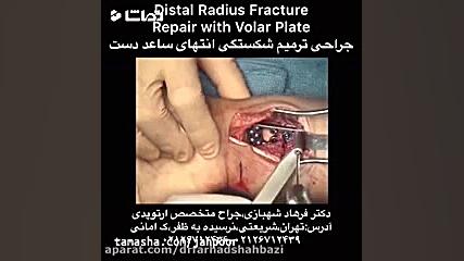 کلیپ پزشکی جراحی شکستگی مچ دست،دکتر شهبازی،پزشک جولیا رابرتس