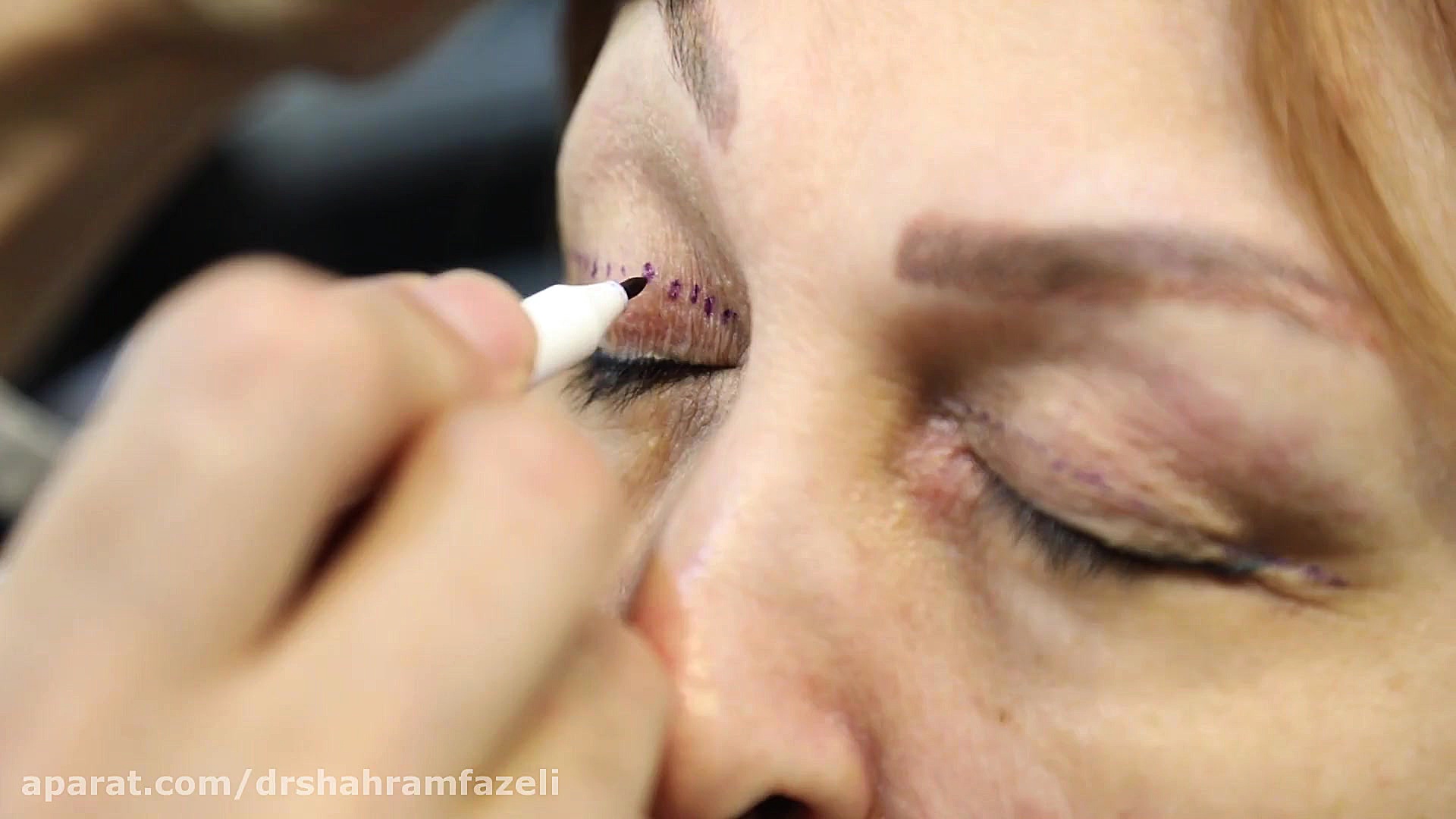 بلفاروپلاستی یا جراحی زیبایی پلک دکتر شهرام فاضلی - فوق تخصص جراحی پلاستیک و زیبایی