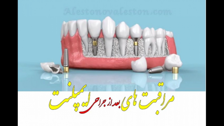 مراقبت های بعد از جراحی ایمپلنت دندان نوروپروستتیک