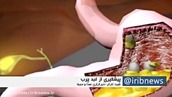 کبد چرب همچون آتش زیر خاکستر