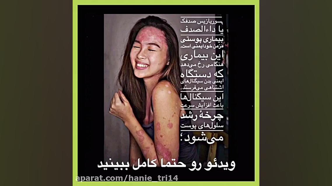 آیا پسوریازیس درمان می‌شود؟ پست اردکی