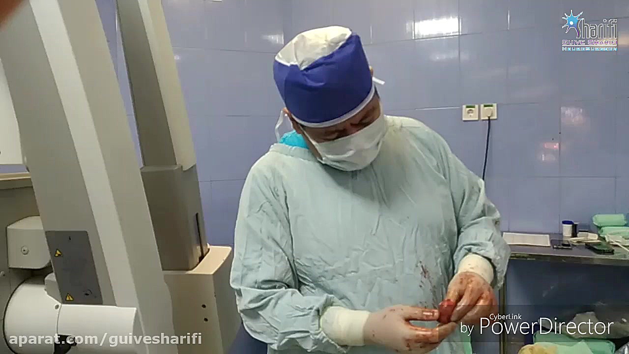 127.تومور قفسه سینه در کودک 5ساله جراحی زیبایی پلک