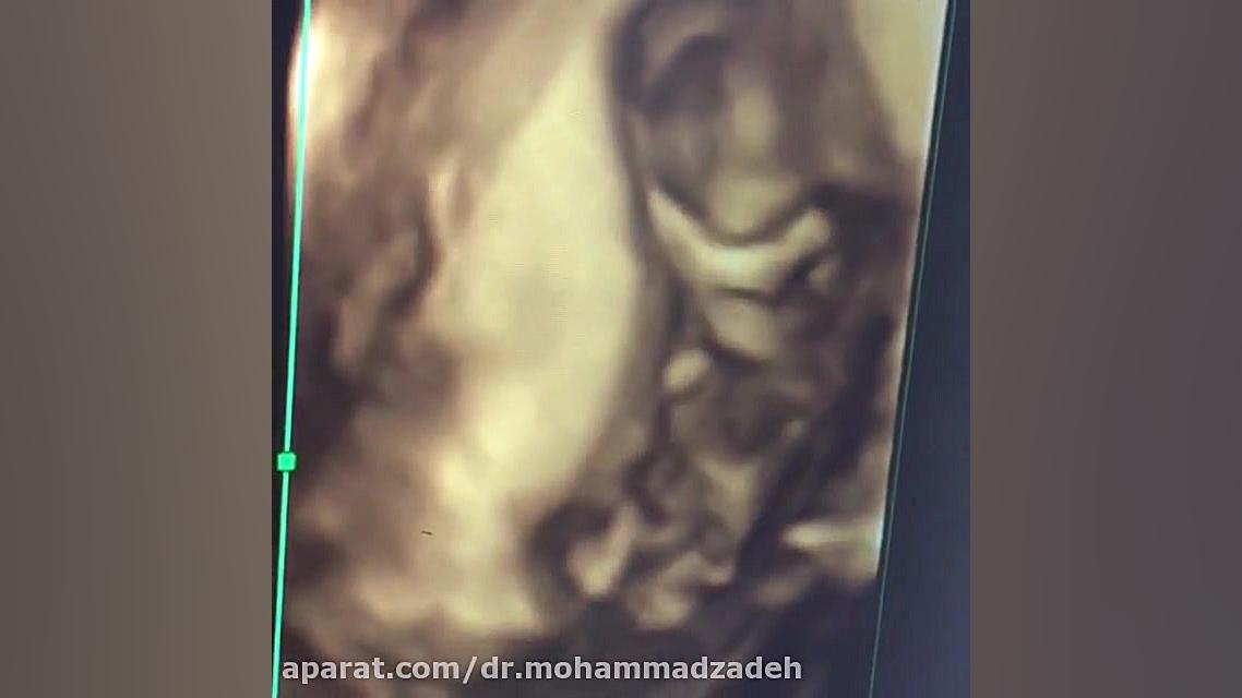 احساس مادر هنگام سونوگرافی میکرونیدلینگ