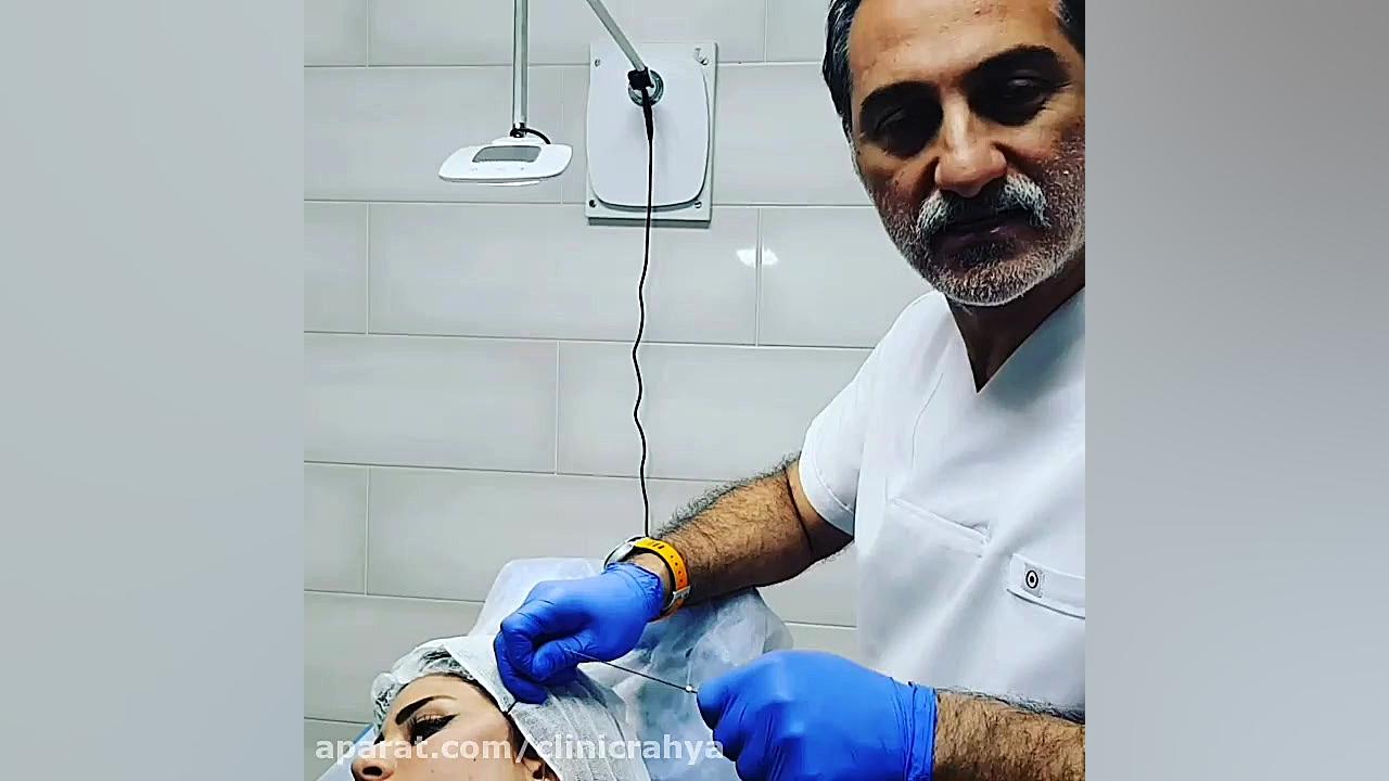 لیفت صورت با نخ الکترود اپتوژنزی