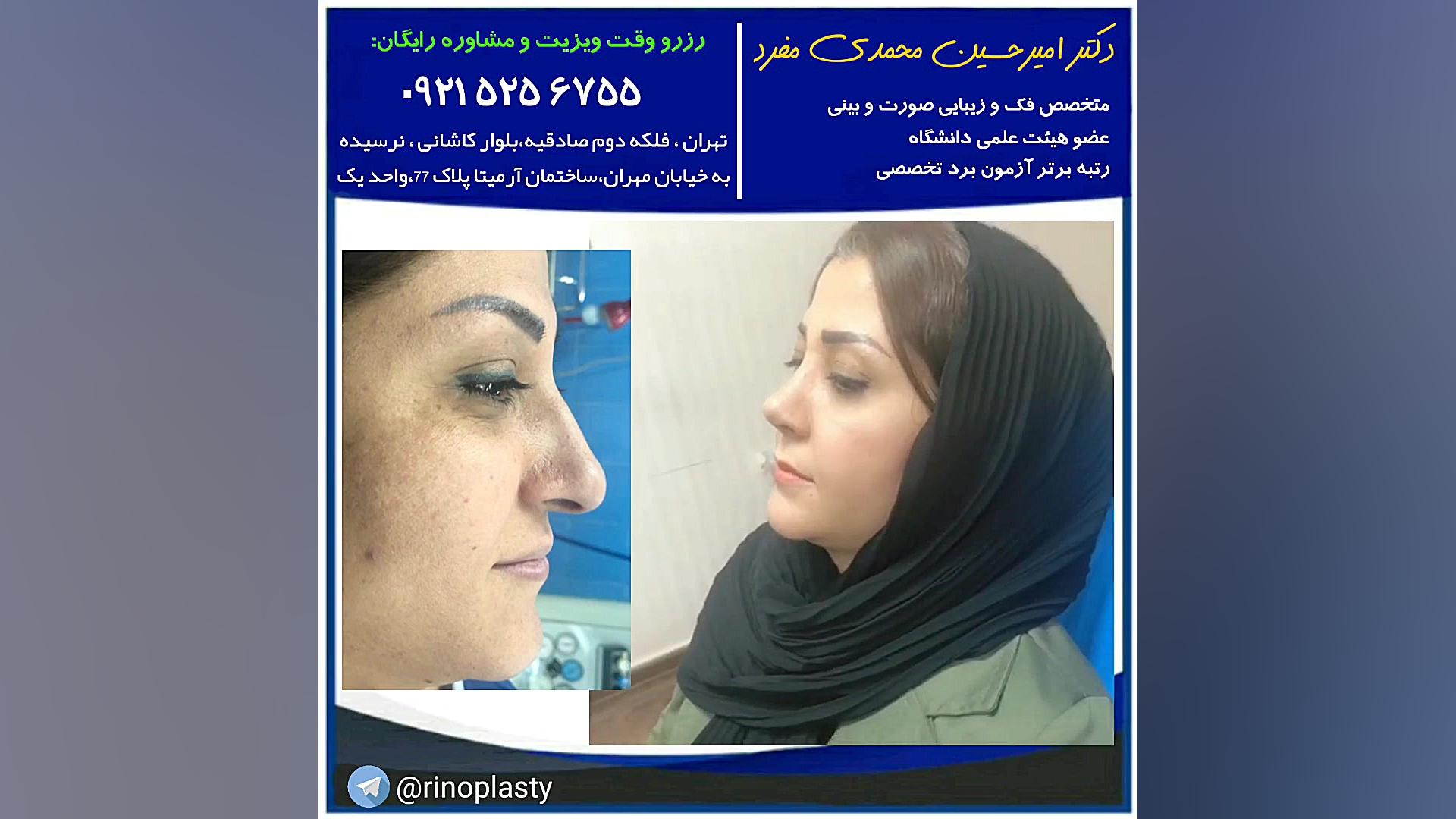 عمل زیبایی بینی (دکتر امیر حسین محمدی مفرد) دکتر امیر حسین محمدی مفرد