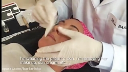 فیلر