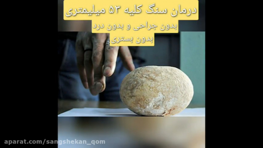 درمان سنگ کلیه ۵۳ میلیمتری بدون جراحی در مشهد جراحی گوش