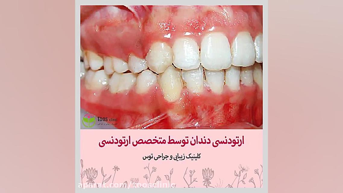 ارتودنسی توسط متخصص ارتودنسی در کلینیک توس اصلاح طرح لبخند