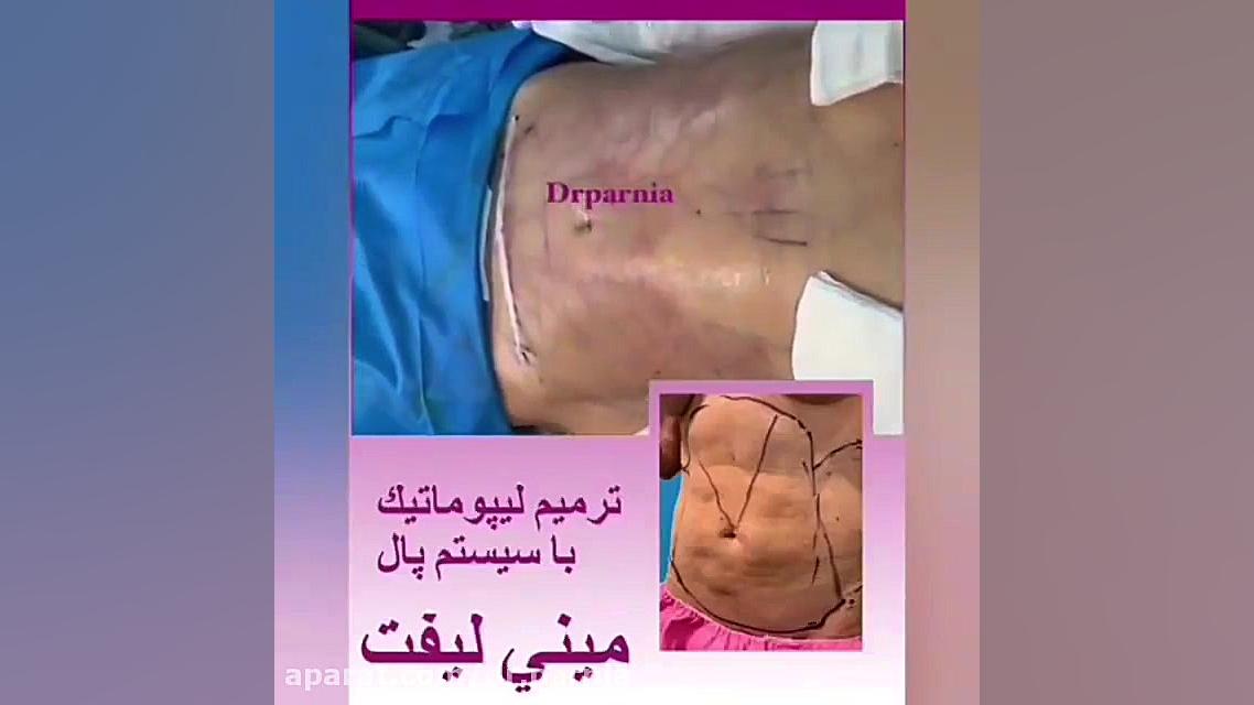 ترمیم لیپوماتیک با دستگاه پال دکتر رفیع پرنیا فوق تخصص پلاستیک