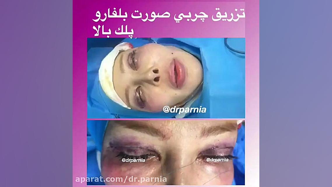 تزریق چربی صورت به همراه بلفاروپلاستی دکتر رفیع پرنیا فوق تخصص پلاستیک